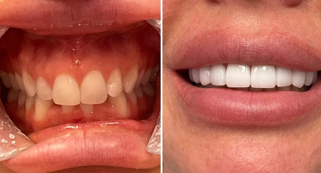 Dental before-and-after case 1 &mdash; Glisten Dental Glendale