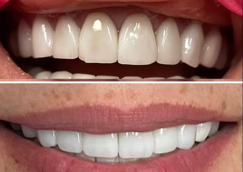 Dental before-and-after case 3 &mdash; Glisten Dental Glendale