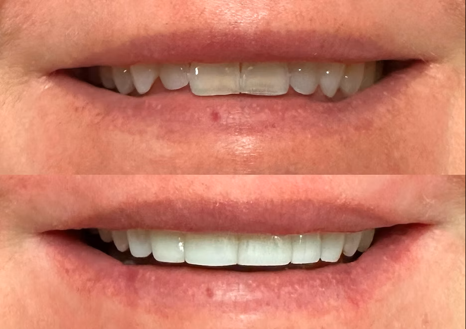 Dental before-and-after case 4 &mdash; Glisten Dental Glendale