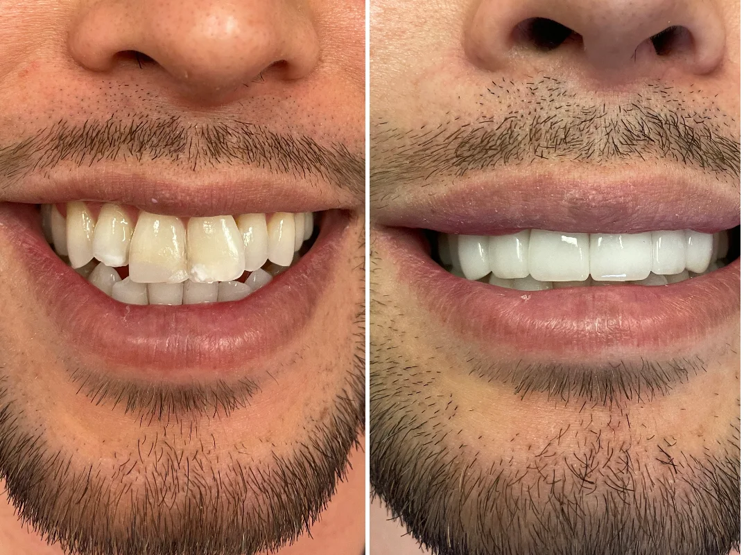 Dental before-and-after case 5 &mdash; Glisten Dental Glendale