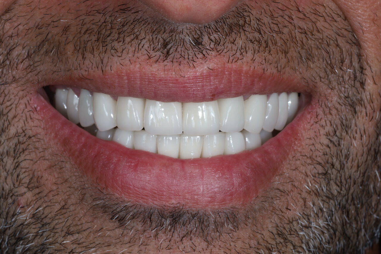 After smile transformation at Glisten Dental Glendale