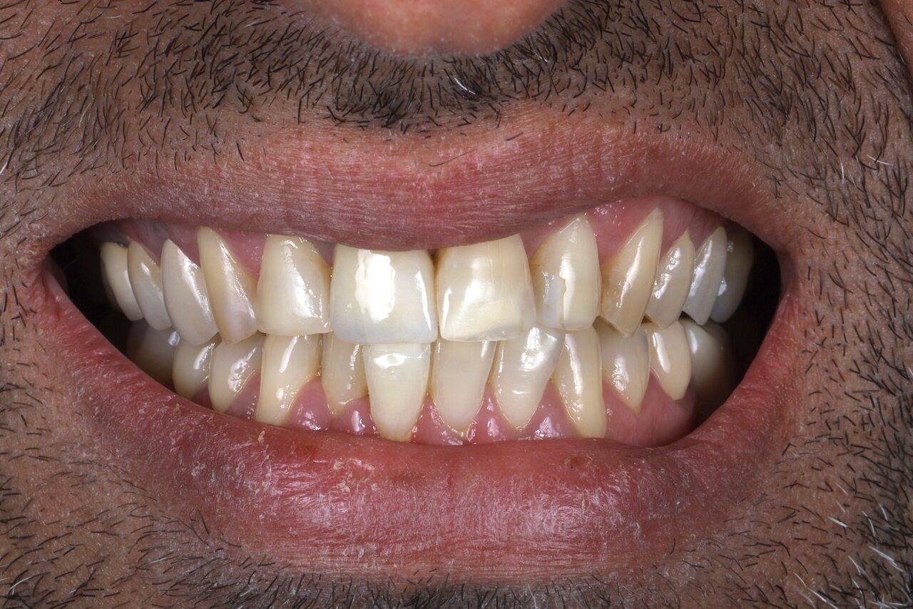 Before smile transformation at Glisten Dental Glendale