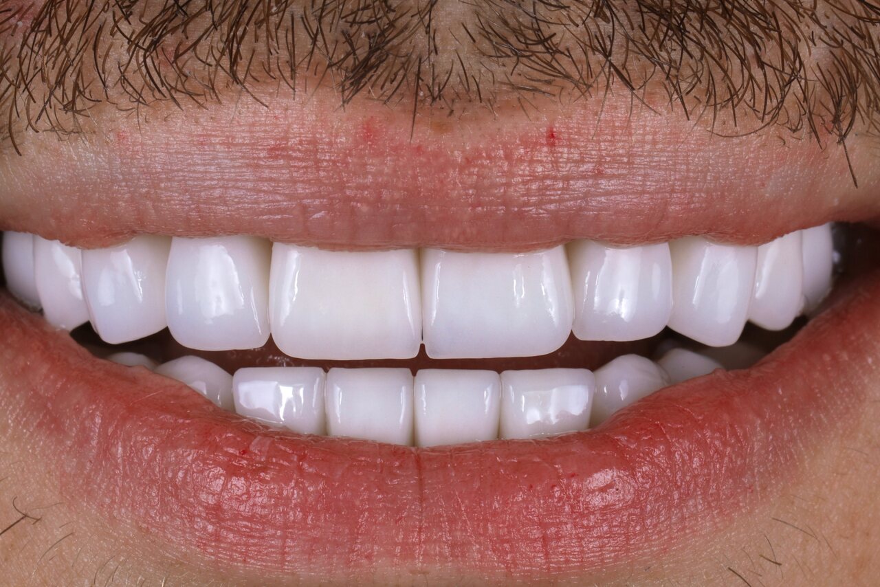 After smile transformation at Glisten Dental Glendale