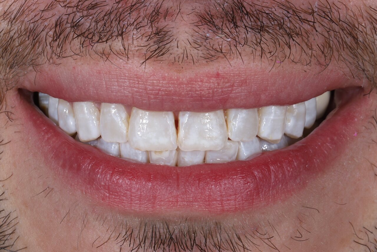 Before smile transformation at Glisten Dental Glendale