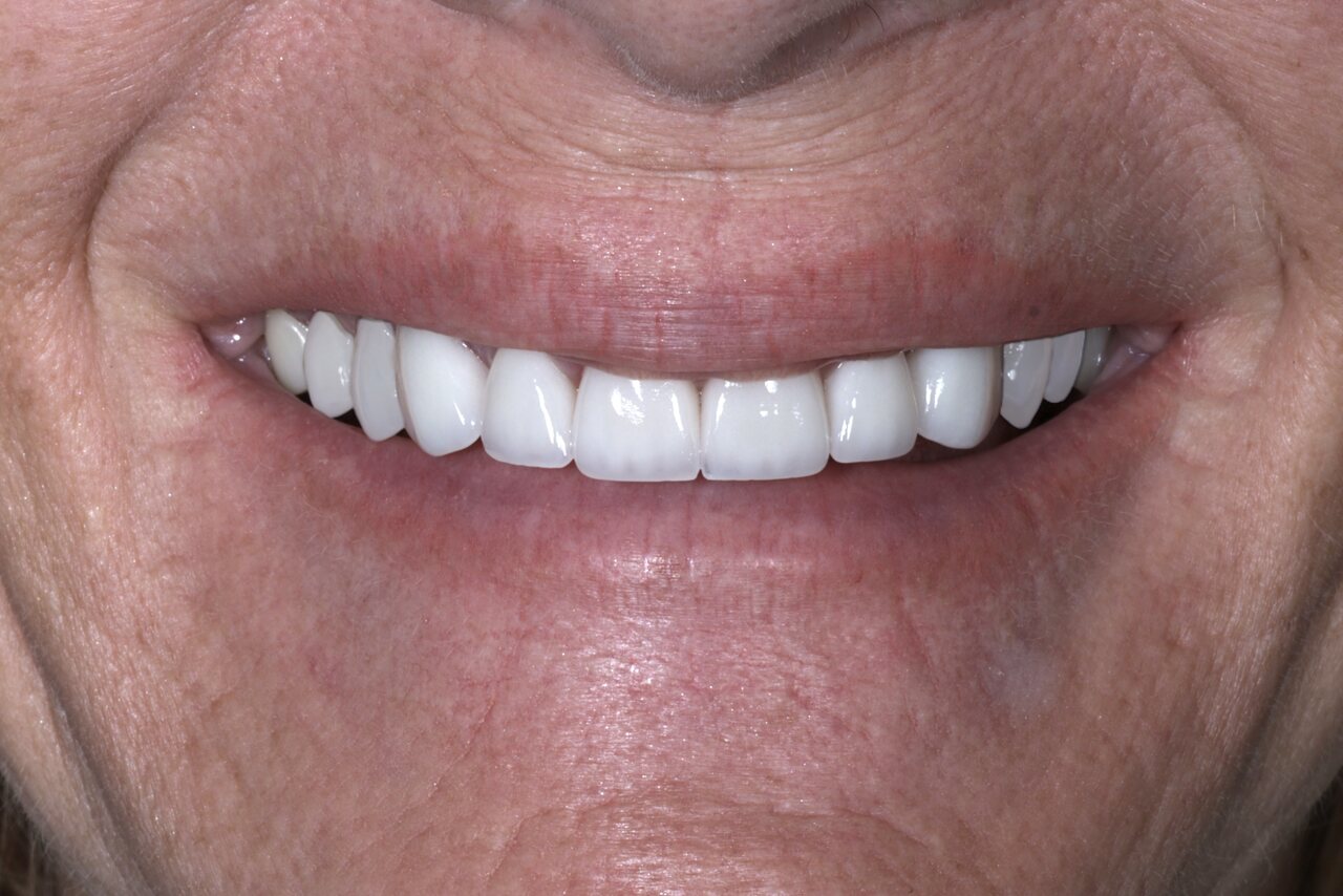 After smile transformation at Glisten Dental Glendale