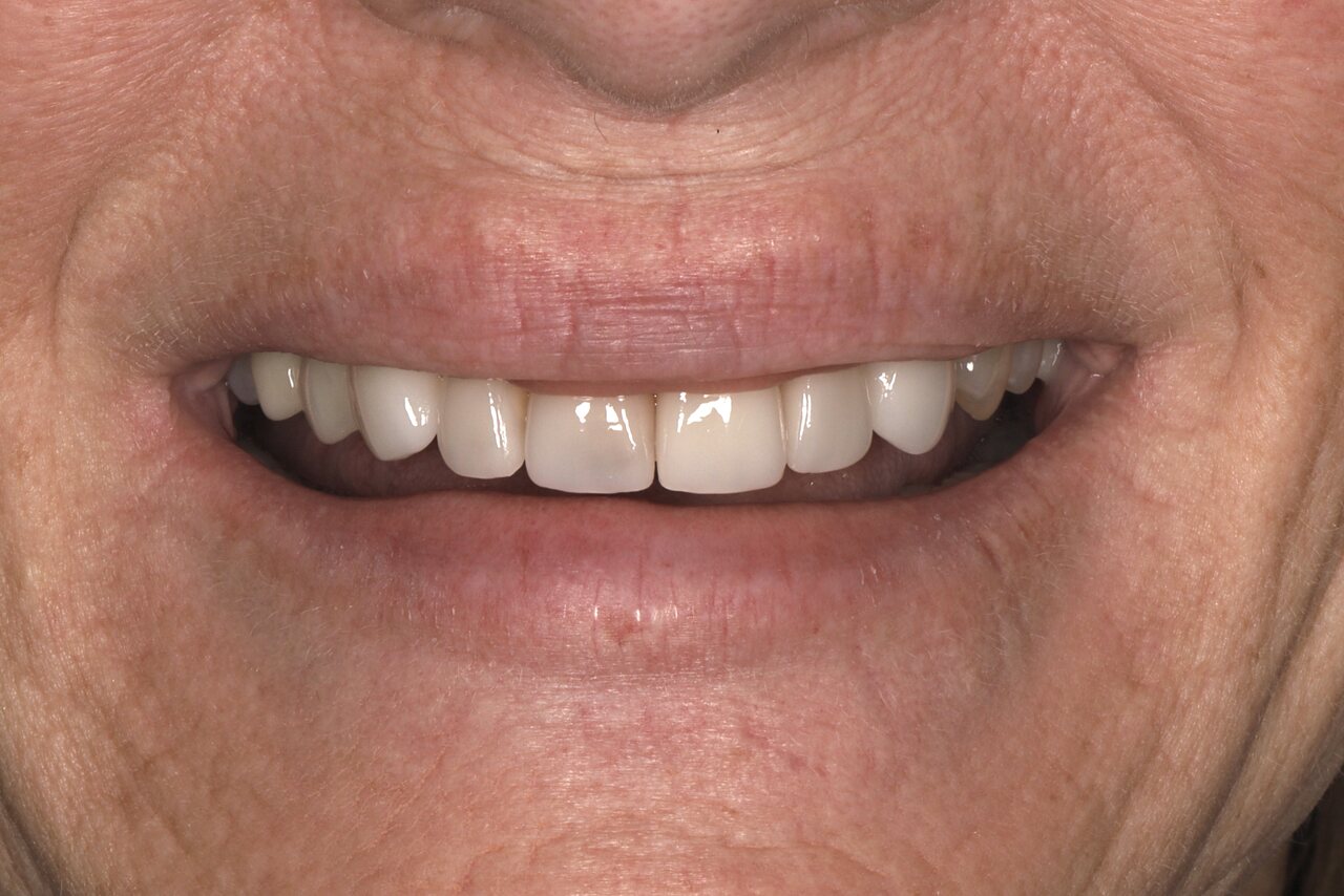 Before smile transformation at Glisten Dental Glendale