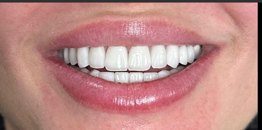 A cosmetic veneer smile result by Dr. Dawood at Glisten Dental Glendale